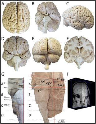 A Topographic Atlas of the Human Brainstem in the Ponto-Mesencephalic Junction Plane